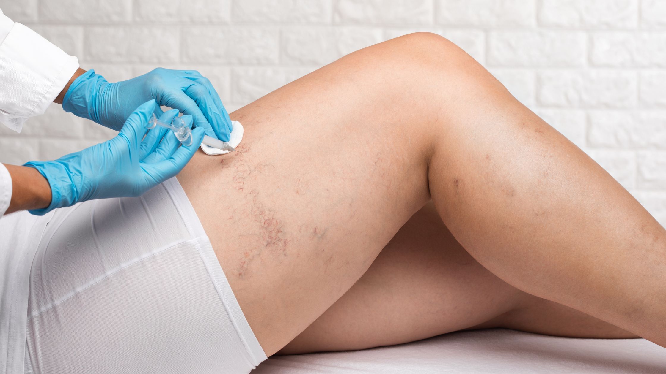 Spider Vein Removal