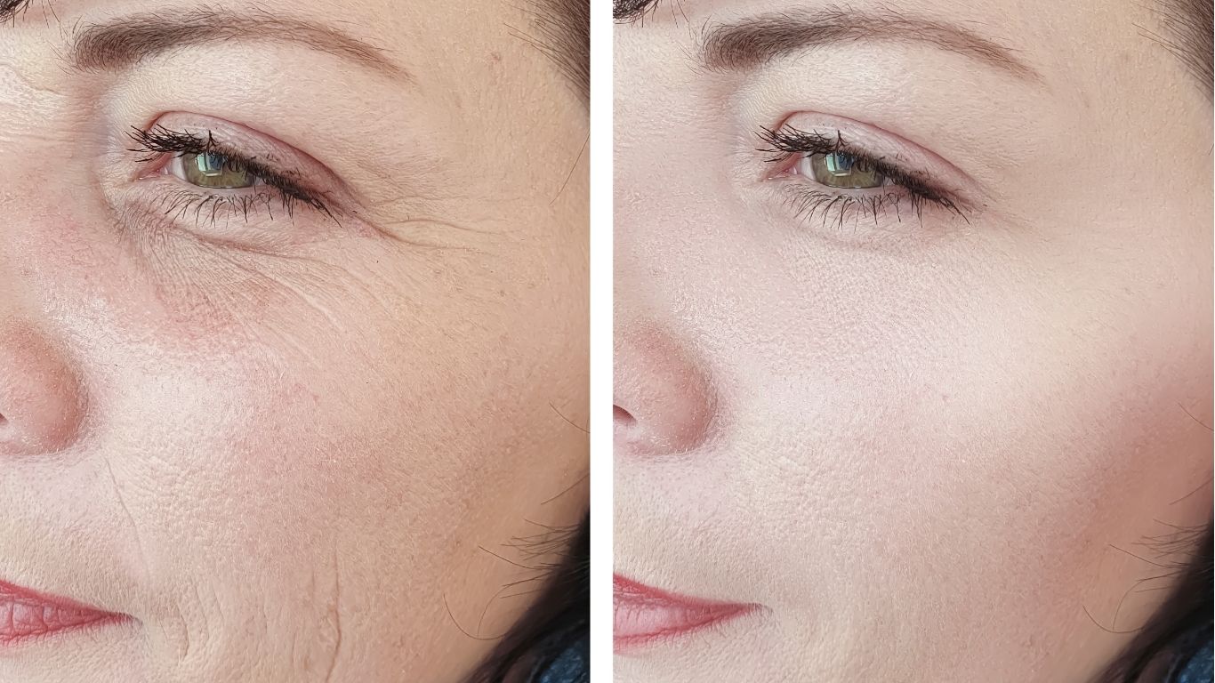 Botox before and after