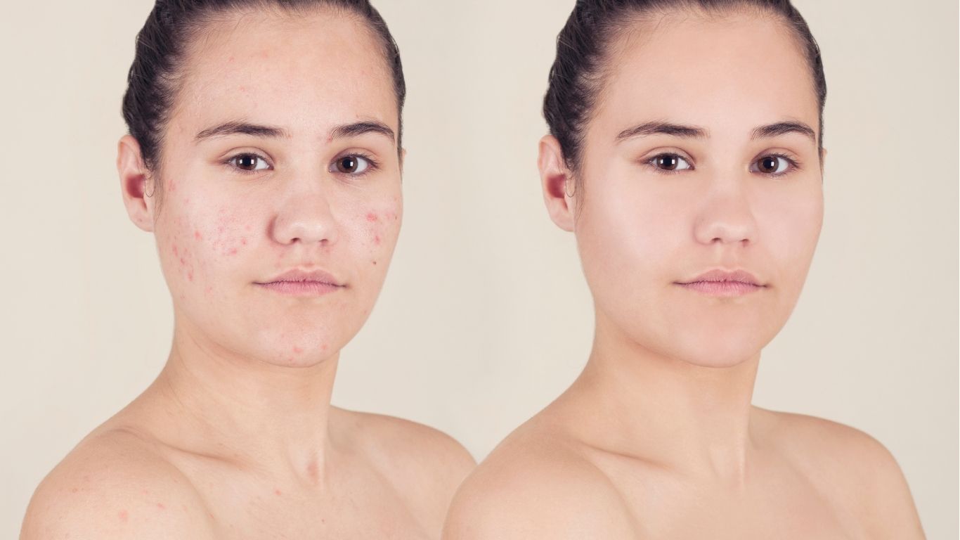 Chemical peels before and after