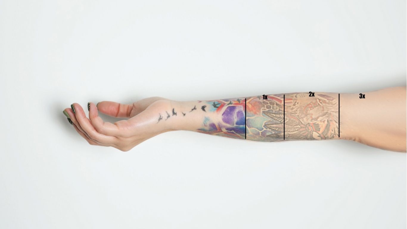 Tattoo removal before and after